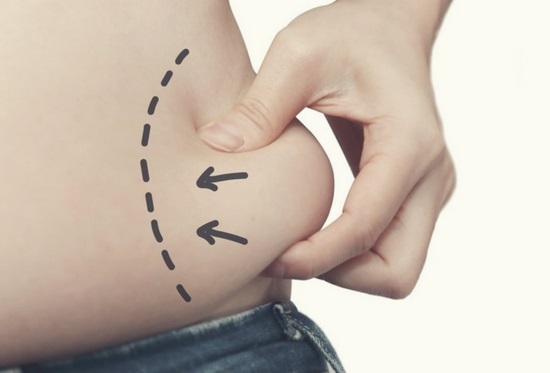 liposucci�n